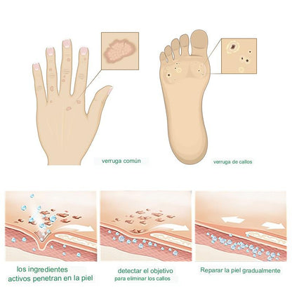 GEL ANTI-HONGOS Y CALLOS + ENVÍO GRATIS